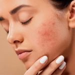 Đừng sờ tay lên mặt nếu không muốn da nổi mụn và xuống cấp