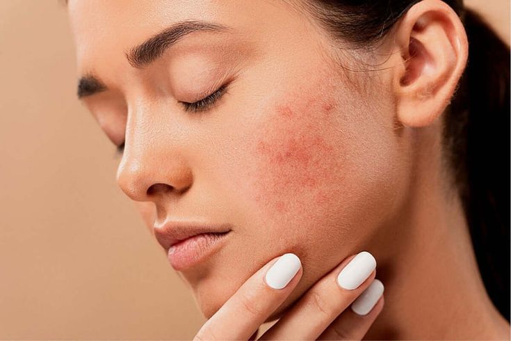 Đừng sờ tay lên mặt nếu không muốn da nổi mụn và xuống cấp