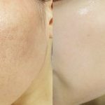 Tạm biệt lỗ chân lông to – Lấy lại làn da mịn màng không tì vết