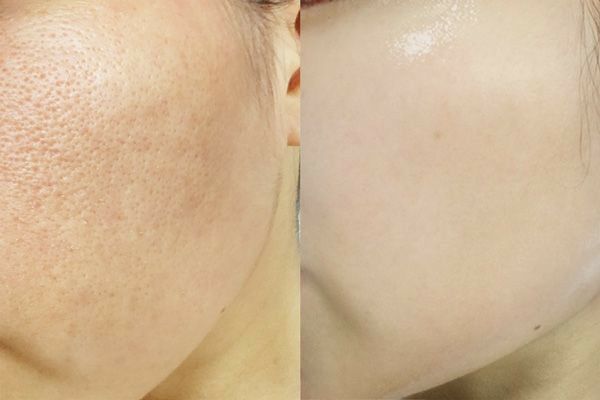 Tạm biệt lỗ chân lông to – Lấy lại làn da mịn màng không tì vết