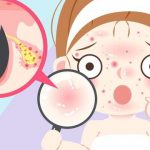 Giải cứu làn da ngày hè: 4 vấn đề phổ biến và cách khắc phục hiệu quả