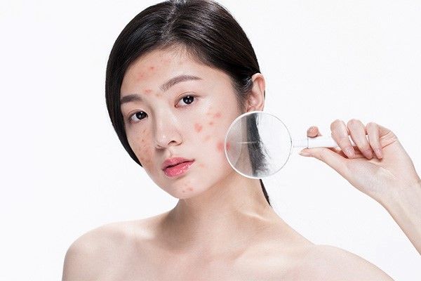 Từ trị mụn đến phục hồi: Hành trình lấy lại làn da khỏe mạnh