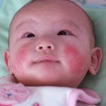 Cảnh giác dị ứng sữa ở trẻ nhỏ: Dấu hiệu nhận biết và cách xử trí