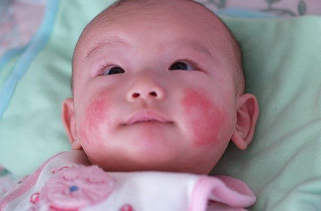 Cảnh giác dị ứng sữa ở trẻ nhỏ: Dấu hiệu nhận biết và cách xử trí