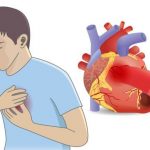 Bác sỹ chỉ ra các triệu chứng báo trước nhồi máu cơ tim