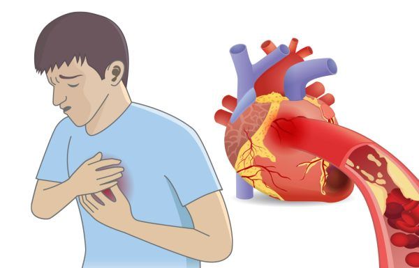 Bác sỹ chỉ ra các triệu chứng báo trước nhồi máu cơ tim