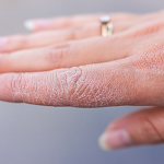 Đừng để da tay nứt nẻ mùa đông: 5 cách chăm sóc cần nhớ