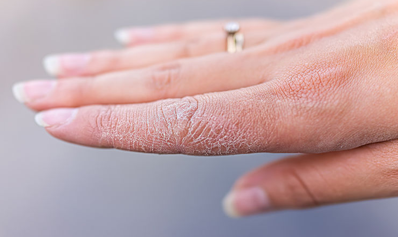 Đừng để da tay nứt nẻ mùa đông: 5 cách chăm sóc cần nhớ