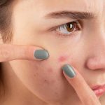 Chăm sóc da sau khi nặn mụn: Bước quyết định để tránh thâm sẹo và tái viêm