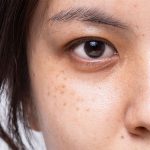 Vì sao chăm sóc da kỹ vẫn bị nám tái phát?