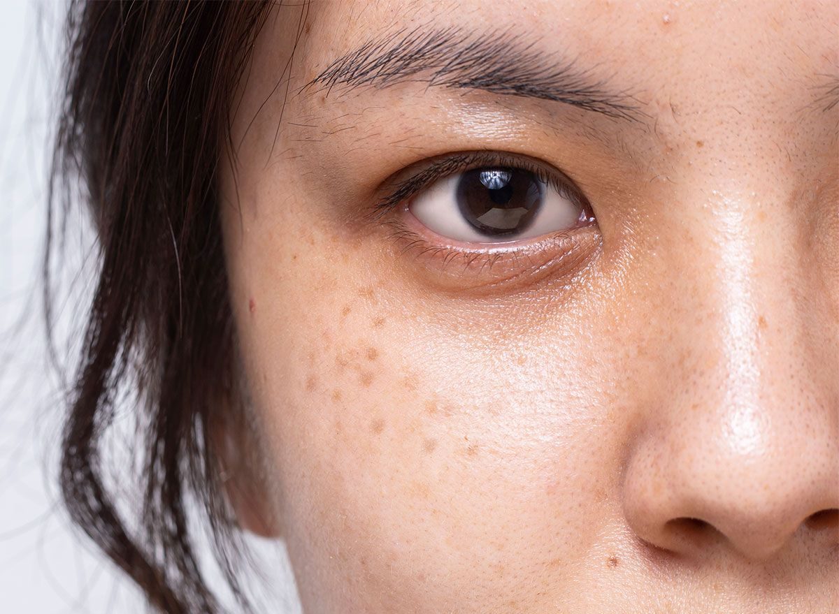 Vì sao chăm sóc da kỹ vẫn bị nám tái phát?