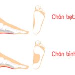 Bàn chân bẹt ở trẻ em: đừng xem nhẹ những dấu hiệu ban đầu
