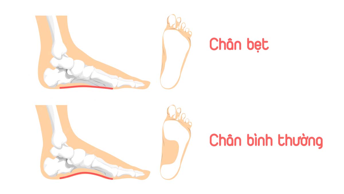 Bàn chân bẹt ở trẻ em: đừng xem nhẹ những dấu hiệu ban đầu