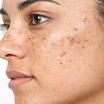 4 lý do khiến lỗ chân lông giãn to và cách chăm sóc da chuẩn khoa học