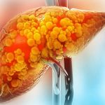 5 thay đổi trong chế độ ăn giúp cải thiện gan nhiễm mỡ