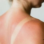 Đi biển về bị cháy nắng? Đây là những bước giúp da phục hồi nhanh hơn