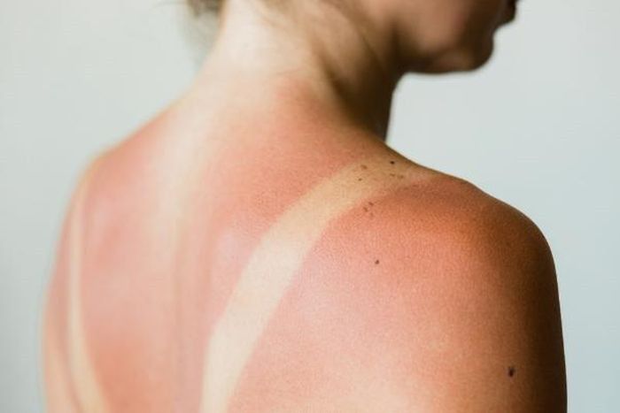 Đi biển về bị cháy nắng? Đây là những bước giúp da phục hồi nhanh hơn