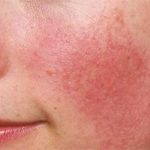 Bị dị ứng mỹ phẩm? Cách xử lý kịp thời và phòng ngừa hiệu quả cho làn da khỏe mạnh