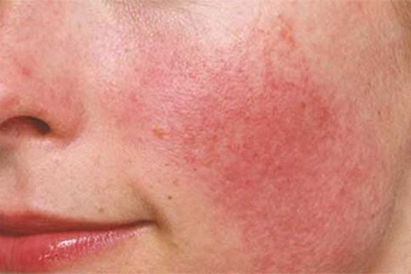 Bị dị ứng mỹ phẩm? Cách xử lý kịp thời và phòng ngừa hiệu quả cho làn da khỏe mạnh