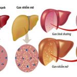 Gan nhiễm mỡ tiến triển âm thầm qua 4 giai đoạn: Phát hiện sớm có thể đảo ngược