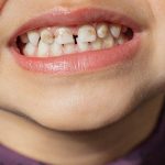 Vì sao răng trẻ xuất hiện mảng bám đen dù vệ sinh đầy đủ?