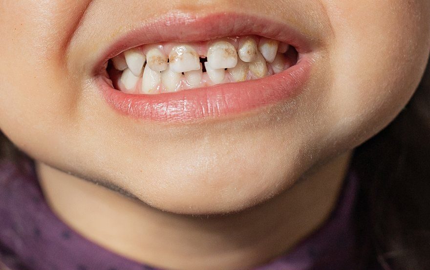 Vì sao răng trẻ xuất hiện mảng bám đen dù vệ sinh đầy đủ?