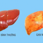 Dinh dưỡng thông minh mỗi ngày giúp ‘giải cứu’ gan nhiễm mỡ từ giai đoạn đầu