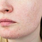 Những sai lầm khiến da khô nẻ nghiêm trọng hơn trong mùa đông