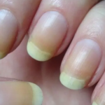 Móng tay bất thường: Đừng bỏ qua dấu hiệu thiếu vitamin