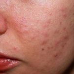 Chuyên gia chỉ ra các dấu hiệu gan nhiễm mỡ dễ nhận thấy trên mặt