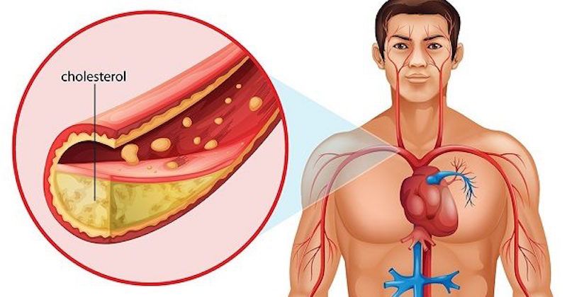 Ăn uống đúng cách giúp giảm cholesterol và ngăn ngừa bệnh tim