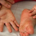 Ăn uống thế nào khi trẻ bị tay chân miệng để không làm bệnh nặng hơn?