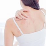 Đổ mồ hôi nhiều mùa hè khiến mụn lưng nghiêm trọng hơn?