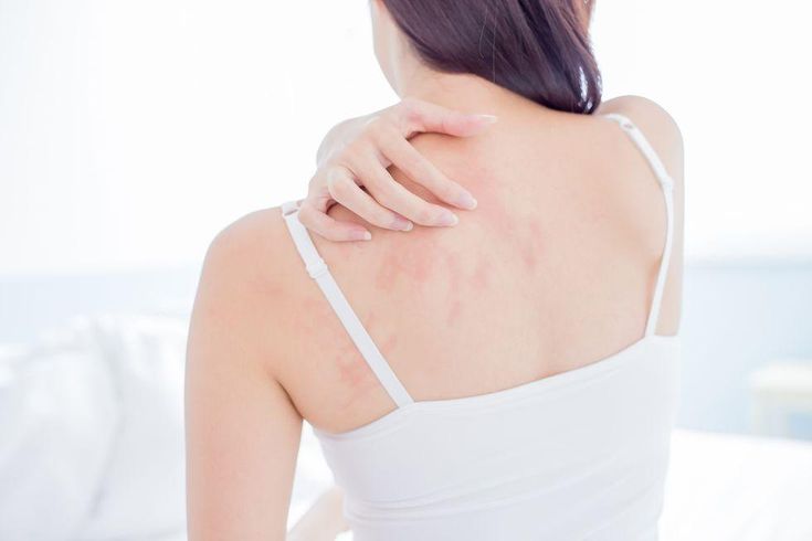 Đổ mồ hôi nhiều mùa hè khiến mụn lưng nghiêm trọng hơn?